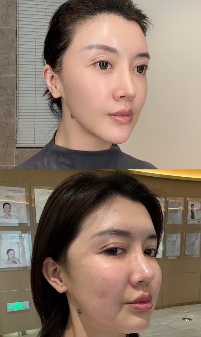 这就是医美填充馒化修复的核心真相