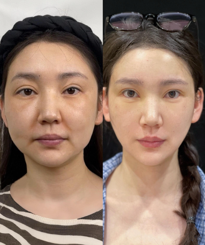 被坑烂脸了五年，躲家里不敢见人，多亏王院帮我修复，救我出泥潭